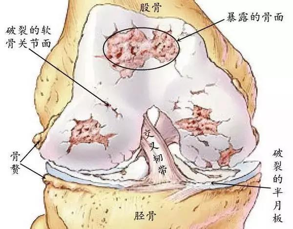 膝关节疼痛