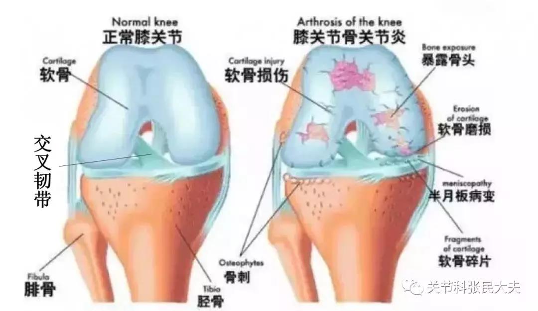 正常膝关节与膝关节骨关节炎