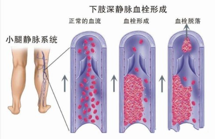 下肢深静脉血栓形成示意图