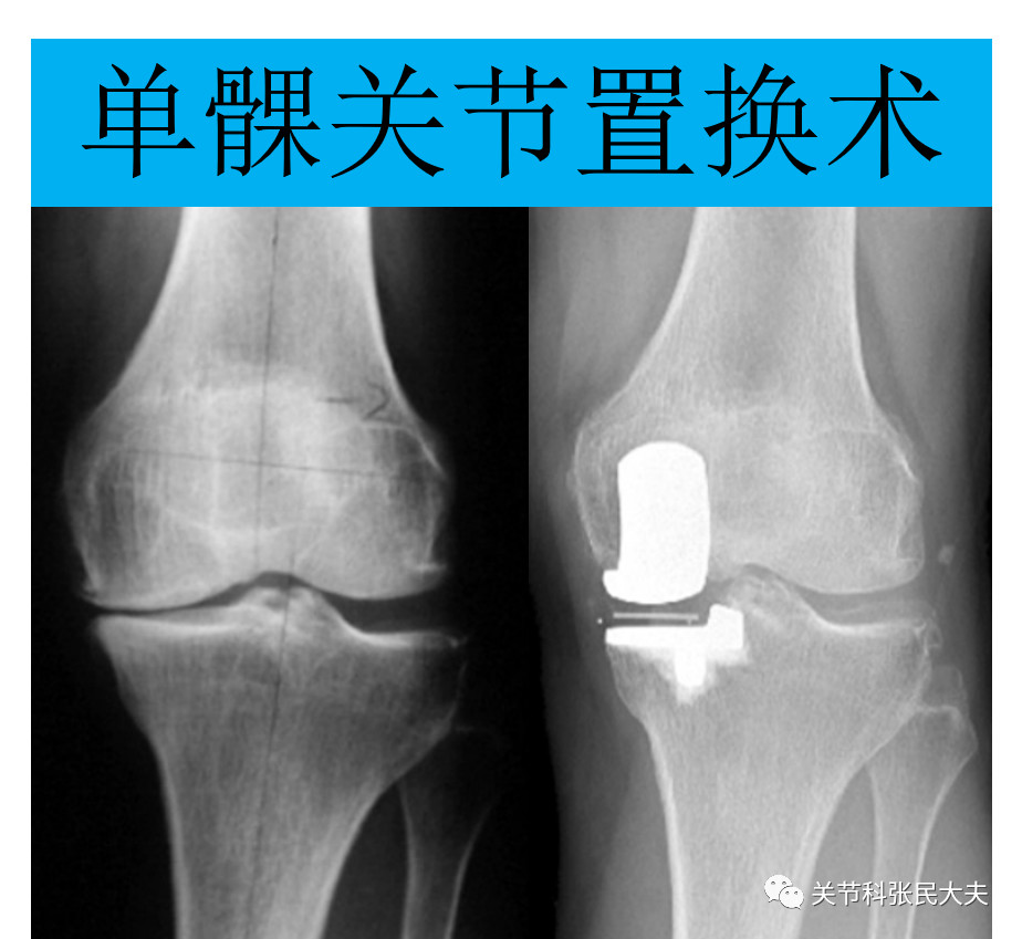 单髁膝关节置换术