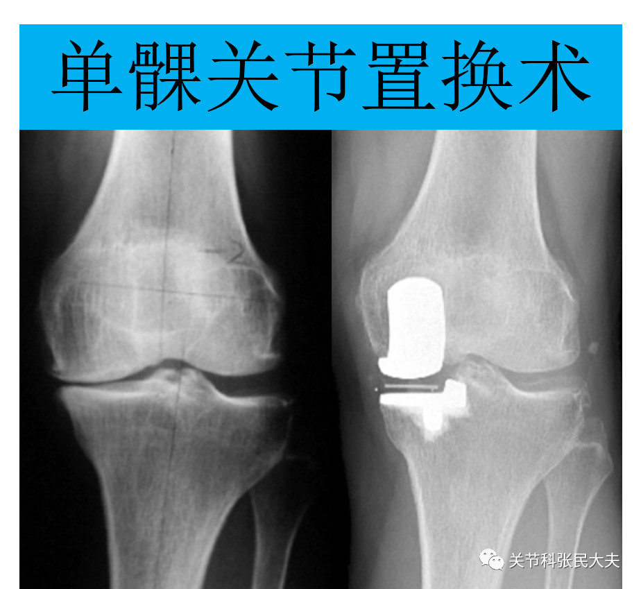 单髁膝关节置换术
