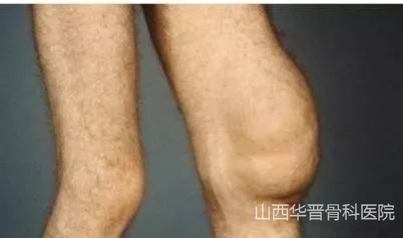 关节积液和滑膜炎
