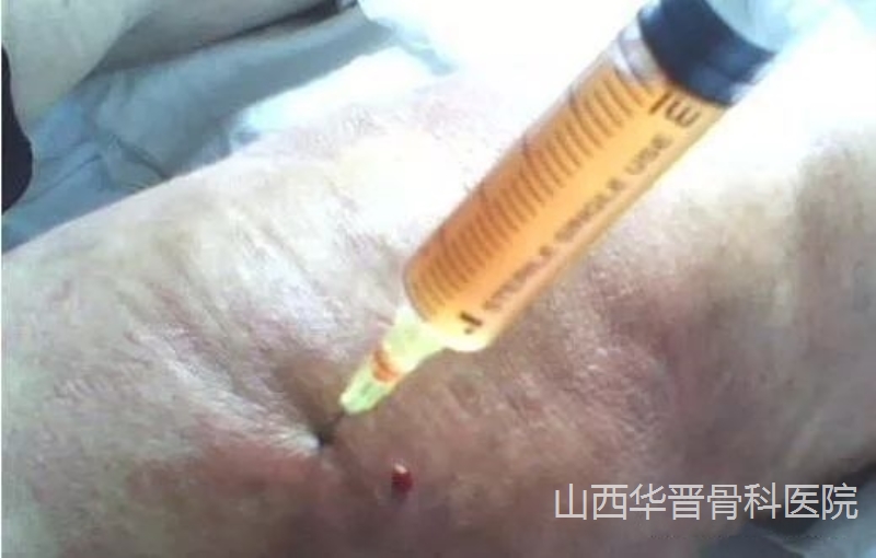 关节积液和滑膜炎到底该不该抽积水?