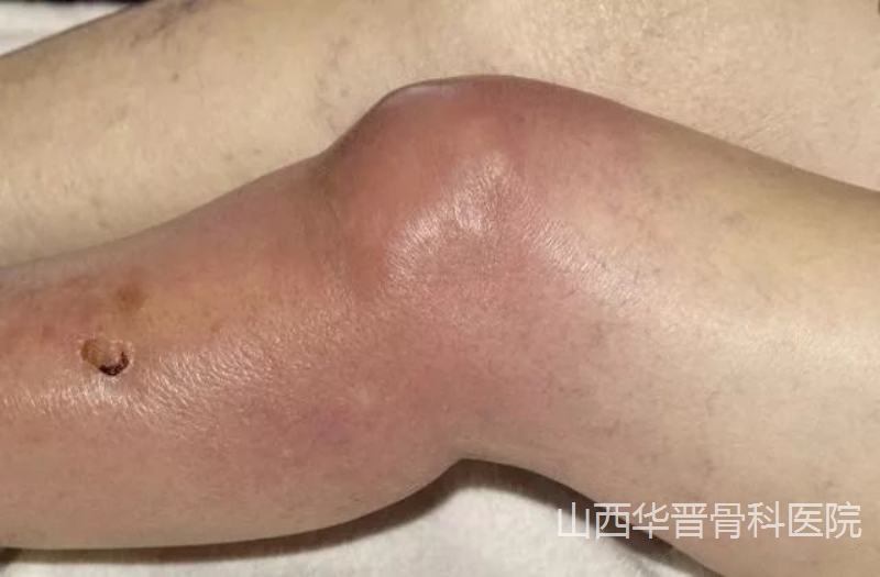 关节积液和滑膜炎到底该不该抽积水?