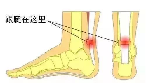 跟腱断裂