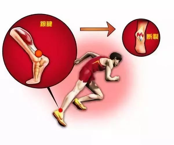 防治急性跟腱断裂