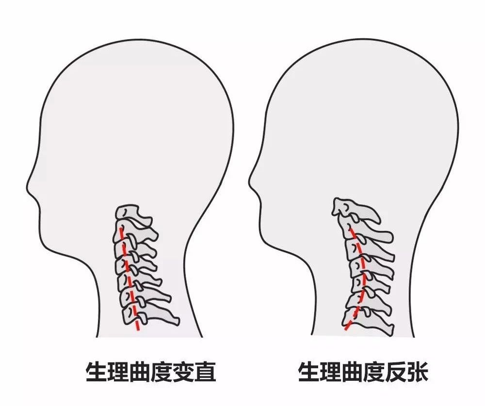 弧度也就随之消失了,变成这样 一旦生理曲度逐渐消失  颈椎承重能力