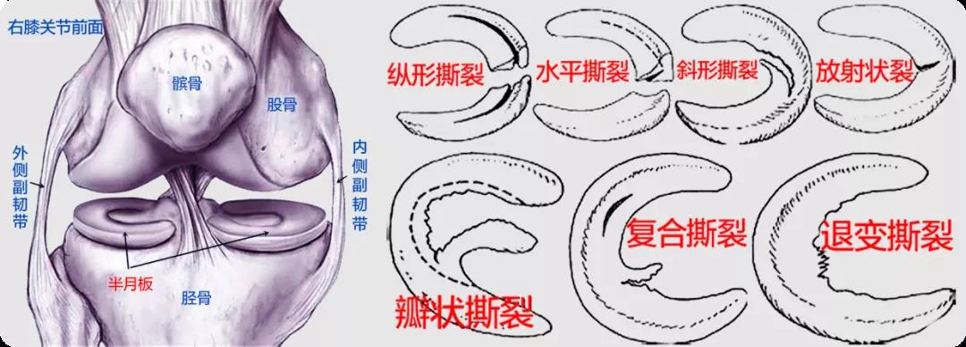 半月板损伤示意图