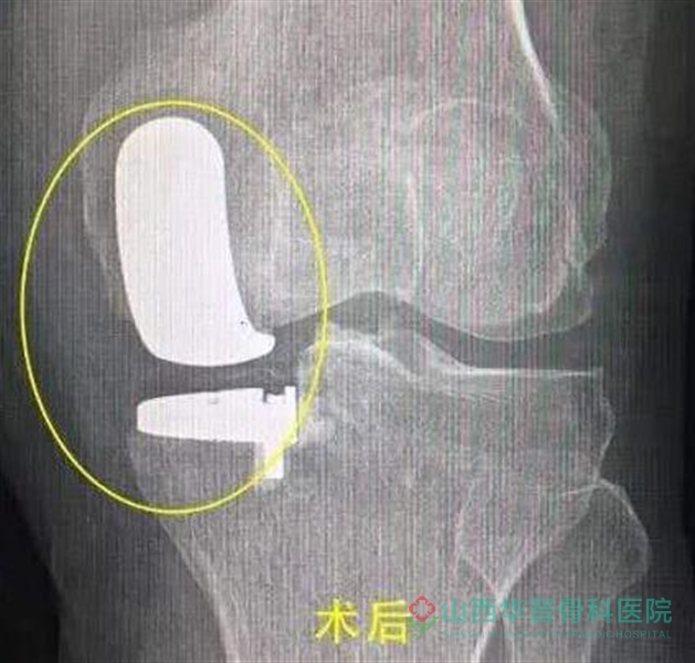 膝关节单髁置换术后