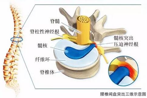 图文结合描述腰椎间盘突出的那点事儿写的真好