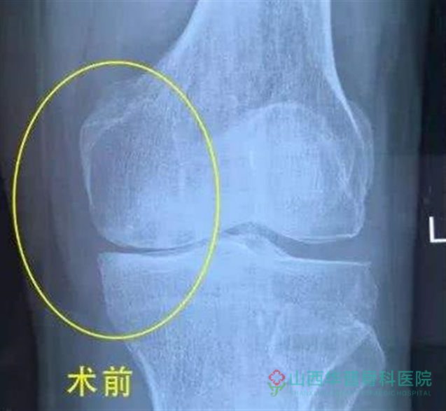 什么是膝关节单髁置换术？-微科普