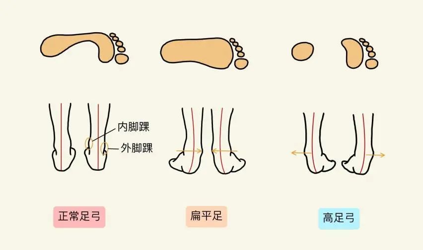 跑步膝盖痛？90%人忽略的真相问题竟出在脚底的三座桥-图片3